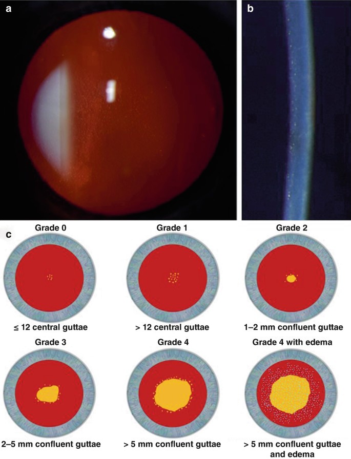 Fuchs Endothelial Corneal Dystrophy | SpringerLink
