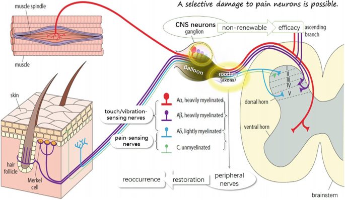 Percutaneous Balloon Compression for Trigeminal Neuralgia Treatment ...