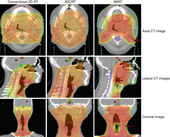 Principles of Radiation Oncology in Children | Springer Nature Link