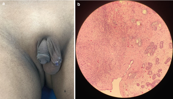 Disorders of Sexual Differentiation | Springer Nature Link