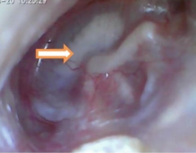 Sade Classification History and Examination of Ear | Springer Nature Link