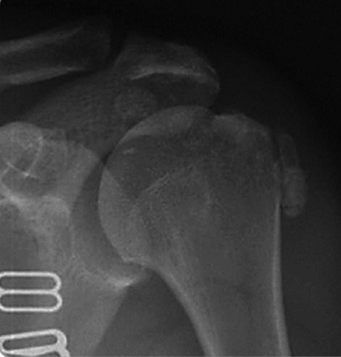 Misdiagnosis of Anterior Shoulder Dislocation Accompanied by Vascular ...
