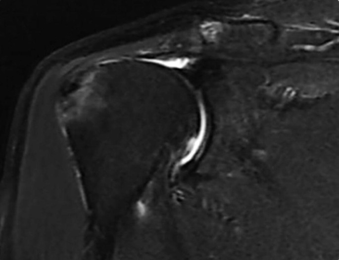 The Neglected Problems and Countermeasures of Massive Rotator Cuff ...