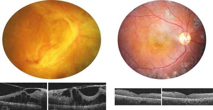 Tractional Rd Oct Tractional Macular Schisis in Proliferative Diabetic Retinopathy ...