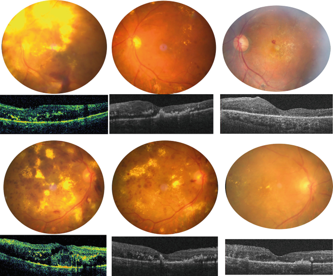 Diabetic Macular Edema with Massive Hard Exudates | SpringerLink