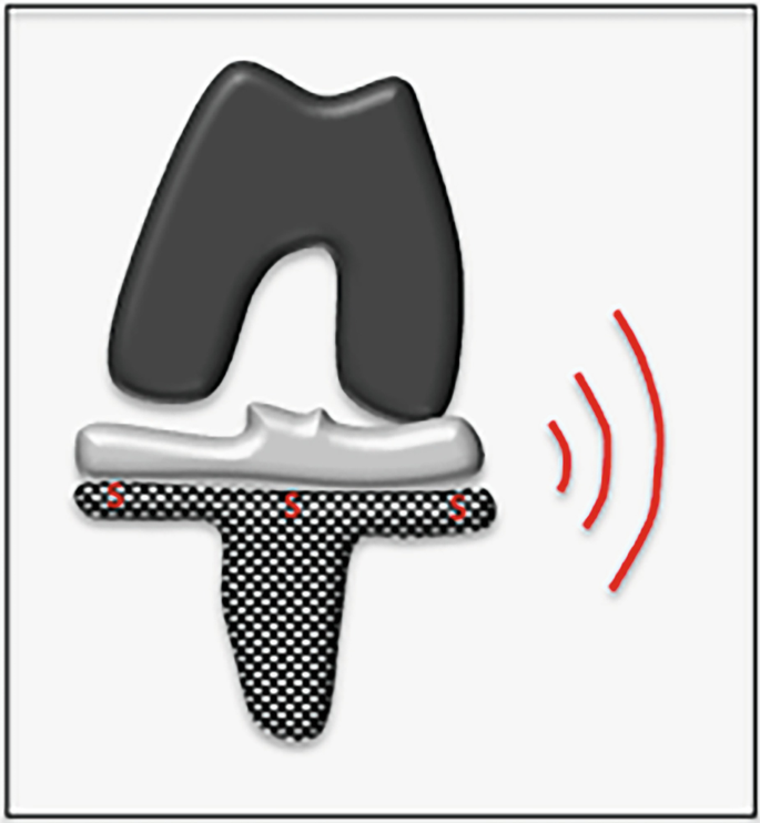 Enhancing Orthopedic Outcomes: The Integration of Sensor-Based ...