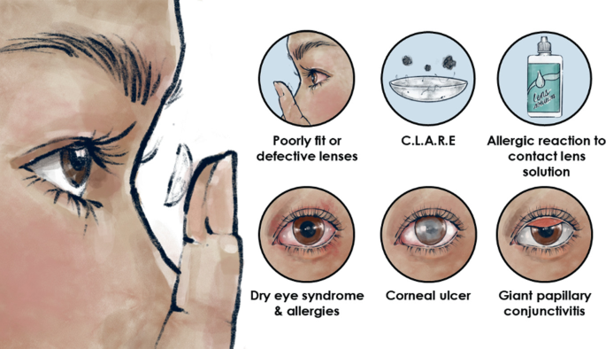 Handling, Mishandling, and Care System of Contact Lenses | SpringerLink