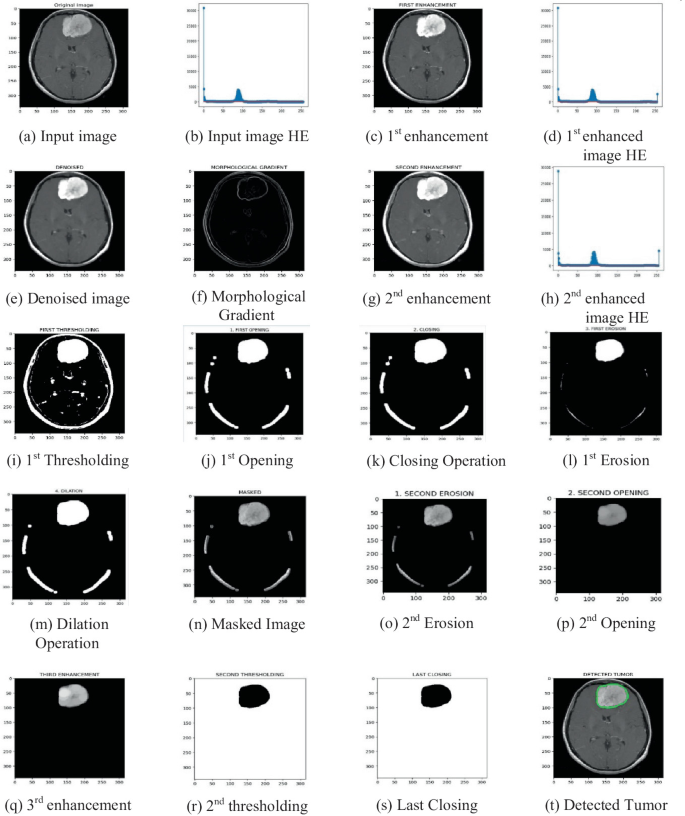 Improving Brain Tumor Segmentation from MR Images Through Integration ...