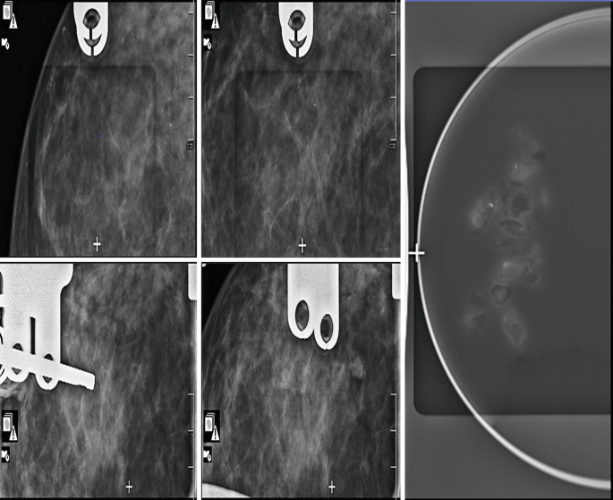 Indeterminate and High-Risk Lesions | Springer Nature Link