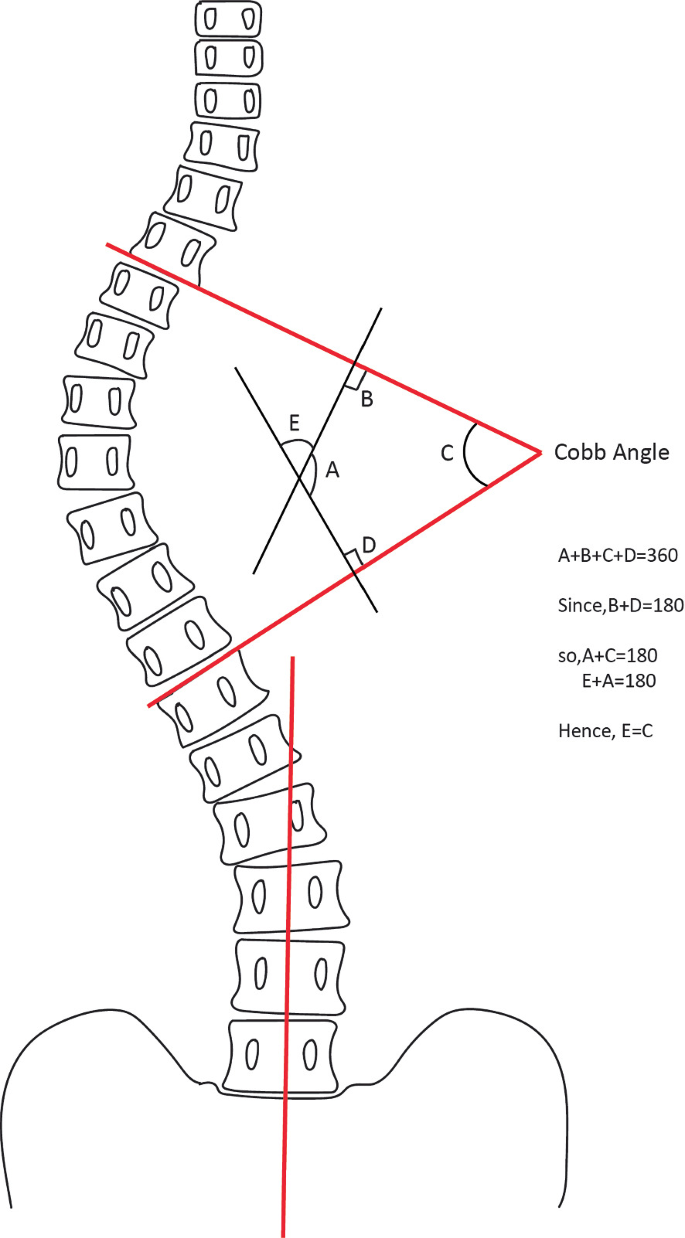 Conceptual Design of a Scoliosis Aiding Brace and a Monitoring ...
