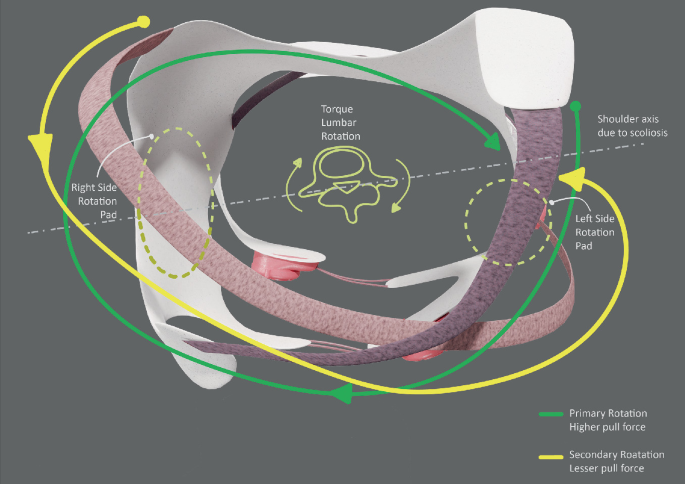 Conceptual Design of a Scoliosis Aiding Brace and a Monitoring ...