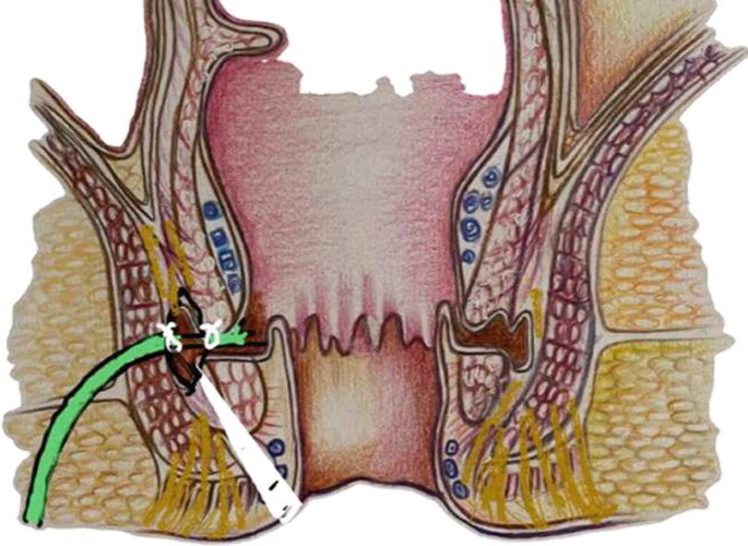 Fistula in Ano: Sphincter Preserving Procedures Ligation of Inter ...