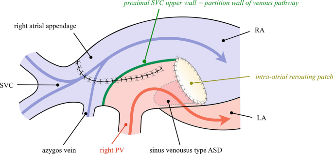 Partial Anomalous Pulmonary Venous Return (PAPVR) | Springer Nature Link