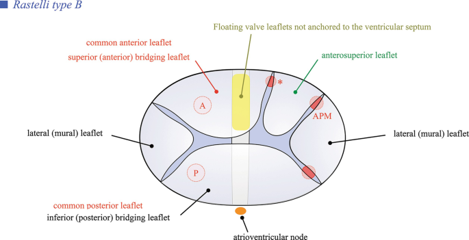 Atrioventricular Septal Defect (AVSD) | Springer Nature Link