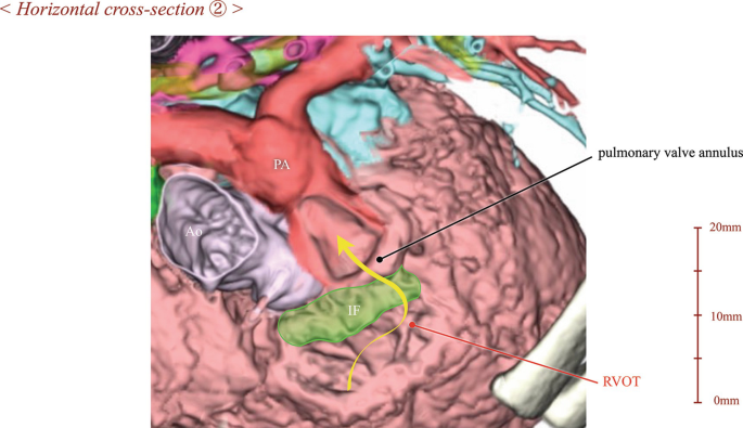 Tetralogy of Fallot (TOF) | Springer Nature Link
