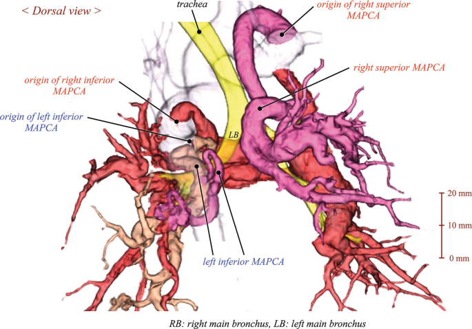 Major Aorto-Pulmonary Collateral Arteries (MAPCA) | Springer Nature ...