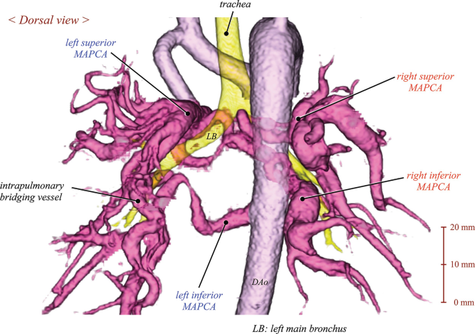 Major Aorto-Pulmonary Collateral Arteries (MAPCA) | Springer Nature ...