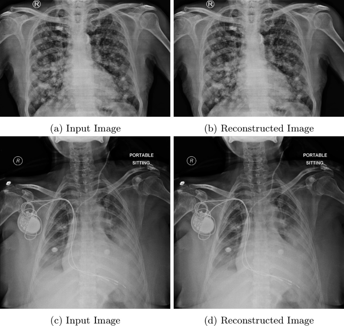An Automated Methodology for Detection of Pulmonary Nodules in Chest X ...