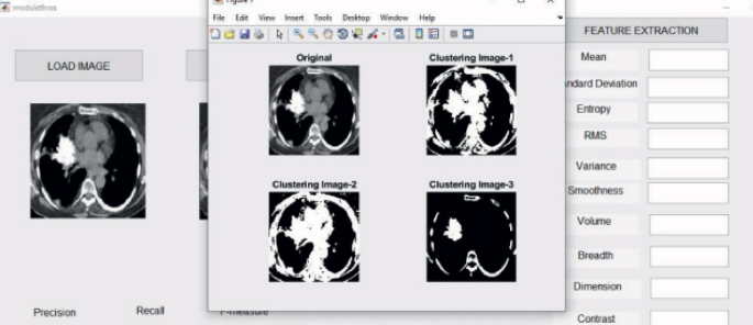 Automated Detection of Lung Cancer Using Deep Learning Models on CT ...