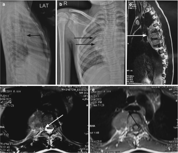 Mediastinal Masses in Children | Springer Nature Link