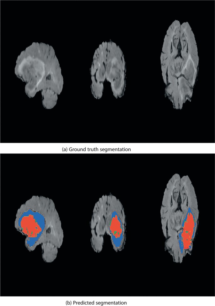 A Novel Segmentation and Classification Approach for Brain Tumours by ...