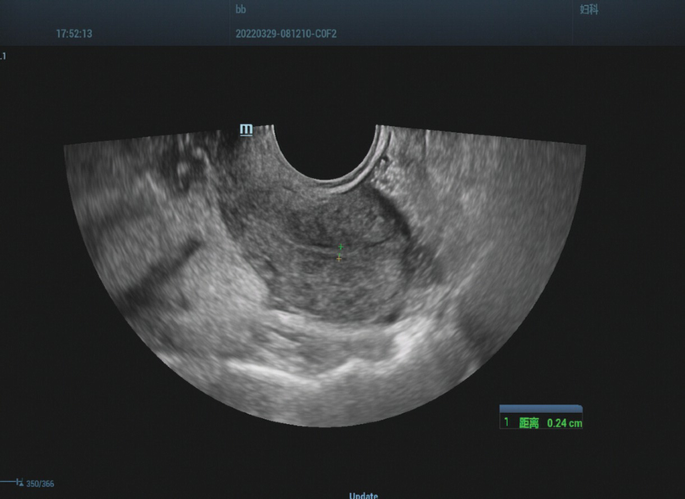 Bladder Surgery: Case 28 Cystoscopy Combined with Laparoscopy for ...
