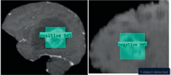 Detection, Segmentation, and Classification on Brain Tumor MRI Dataset ...