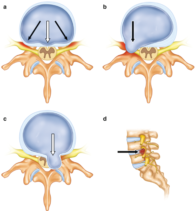 Anatomy of the Spine: Foundation for Understanding Degeneration ...
