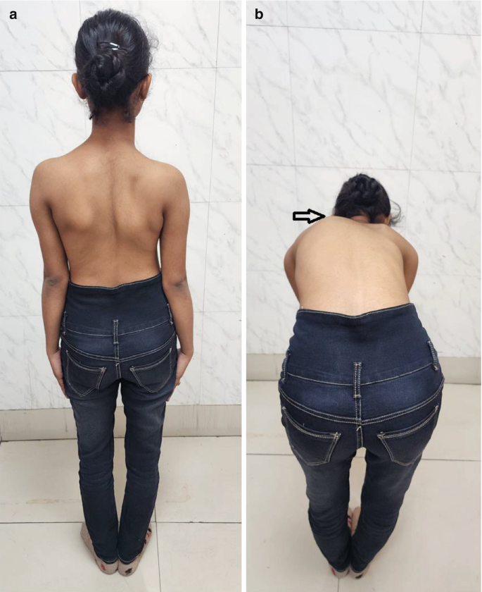 Degenerative Kyphosis and Scoliosis | Springer Nature Link