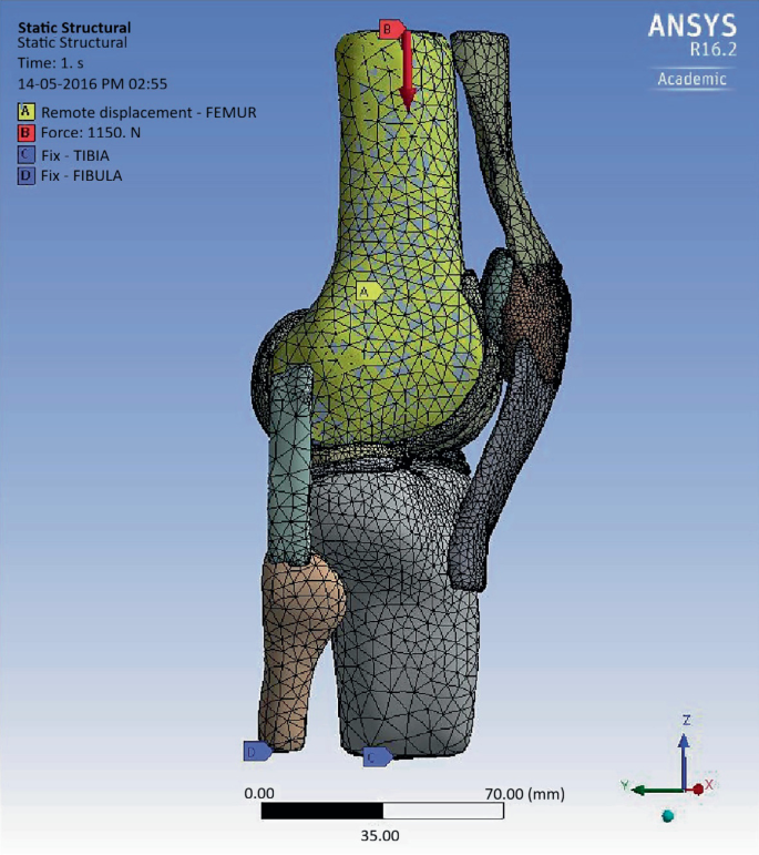 Finite Element Analysis (FEA) on Knee Prosthesis | SpringerLink