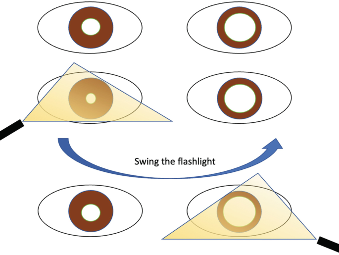 The Pupil and Pupillary Reflexes SpringerLink