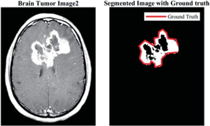 Brain Tumor Localization Using Deep Ensemble Classification and Fast ...