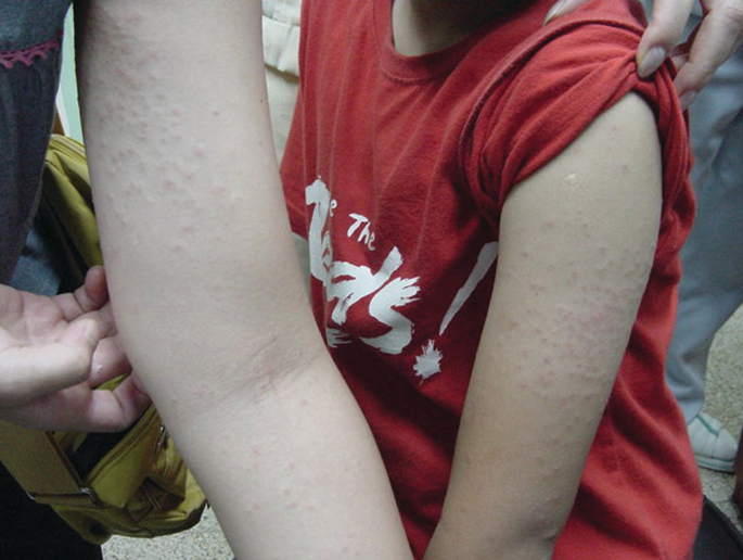 Moth Dermatitis: Poisonous Moth Dermatitis and Caterpillar Dermatitis ...