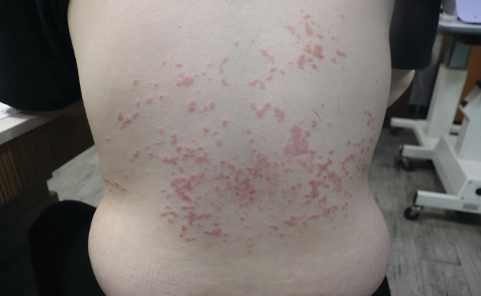 Prugio Rash Prurigo Pigmentosa | SpringerLink