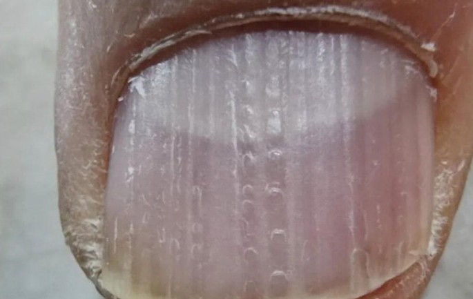 Longitudional Ridges Longitudinal Ridges | Springer Nature Link