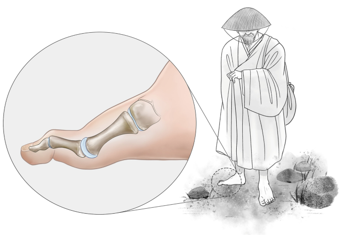 A sketch depicts a Buddhist monk whose foot is enlarged as an inset image where there is a deformity in the bone.