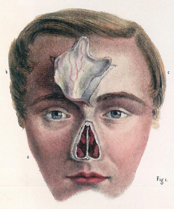 An illustration of a face looking straight with the visible coronal sections of the nose and forehead.