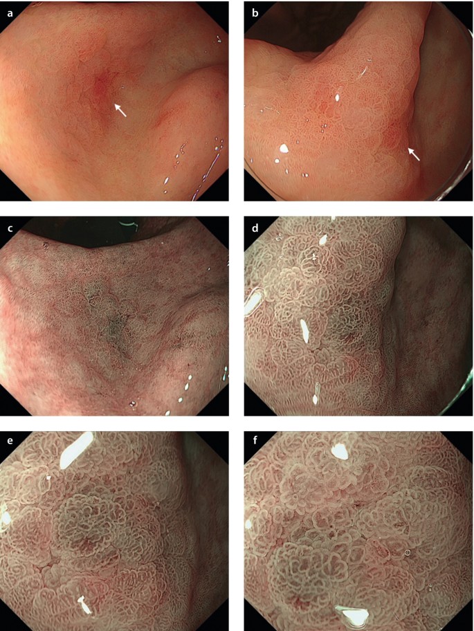 Mucosal Pattern Early Gastric Cancer After HP Eradication (2) | Springer Nature Link