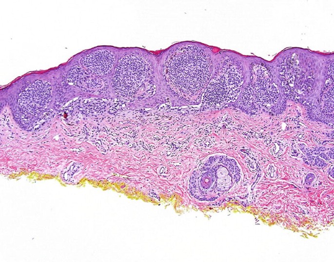 Vulvar Melanocytic Lesions | Springer Nature Link