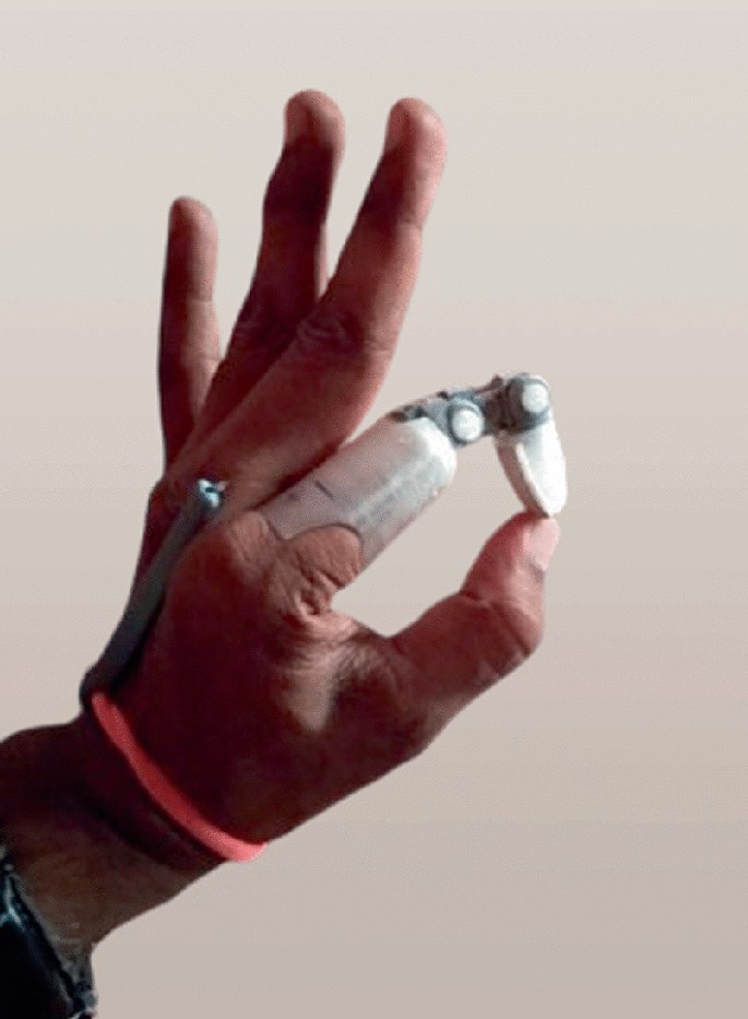 3D Printing Applications in Upper Limb Prosthetics: Hand and Finger ...