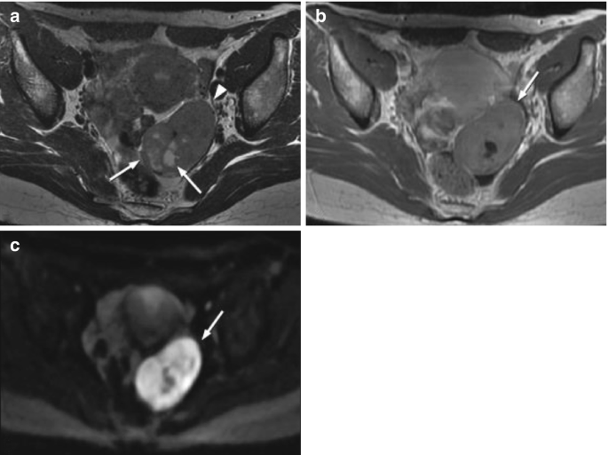 Ovarian Malignant Tumors with Mixed Solid and Cystic Areas: E. Imaging ...