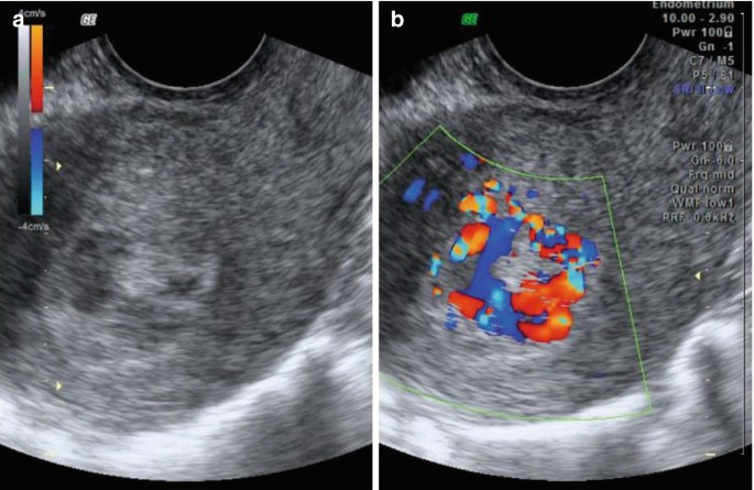 Imaging of Placental Polyps (RPOC) | SpringerLink