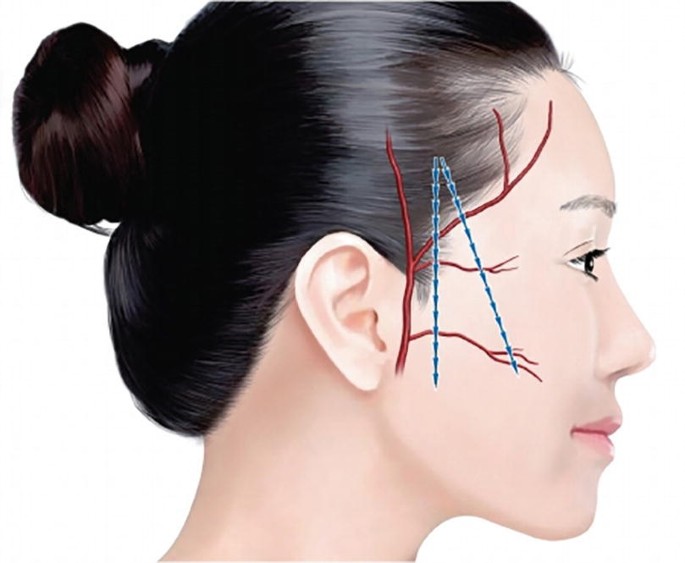 Recent Advances in Thread Lifting SpringerLink