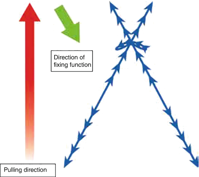 Thread Direction Arrows Various Techniques for Thread Lifting | Springer Nature Link