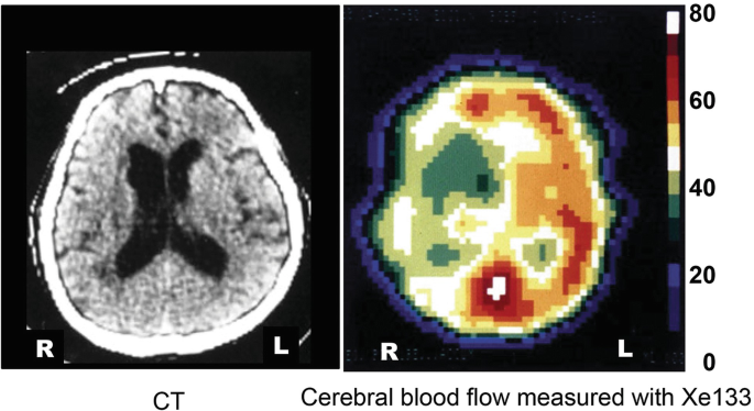 Measuring Cerebral Blood Flow: Methods | SpringerLink