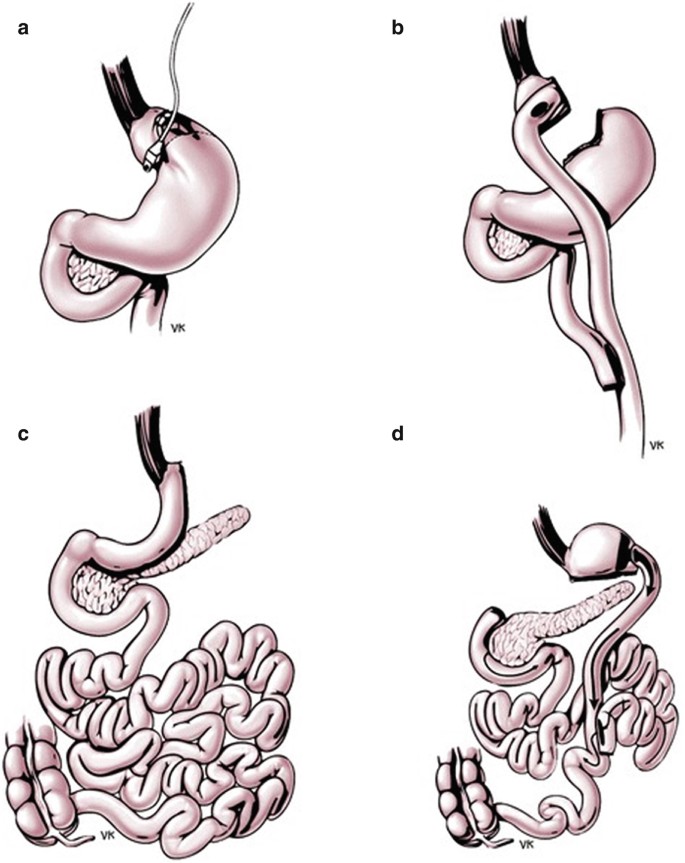 The Management of Overweight and Obese Diabetic Patient SpringerLink