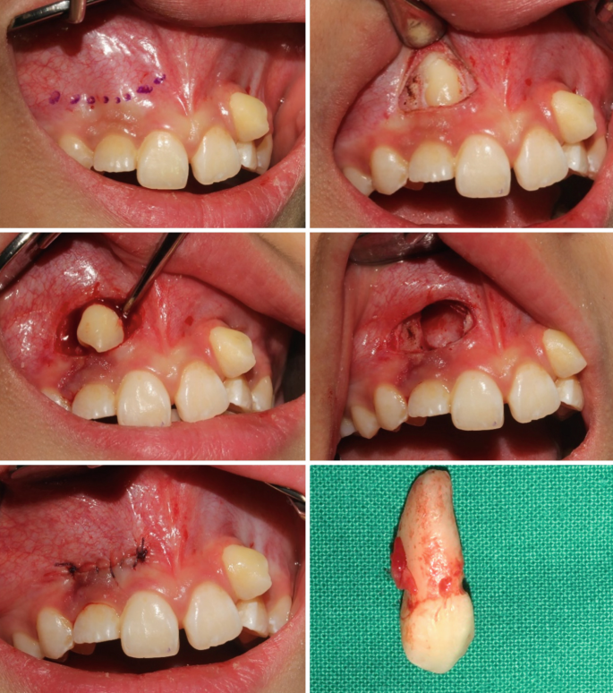 Techniques for Managing Impacted Canine SpringerLink