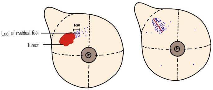 Accelerated Partial Breast Irradiation [APBI]: Current Status and ...