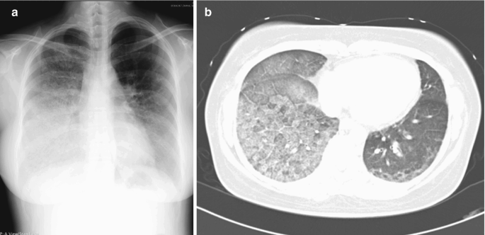 Cryptogenic Organizing Pneumonia (COP) in the Lung | SpringerLink
