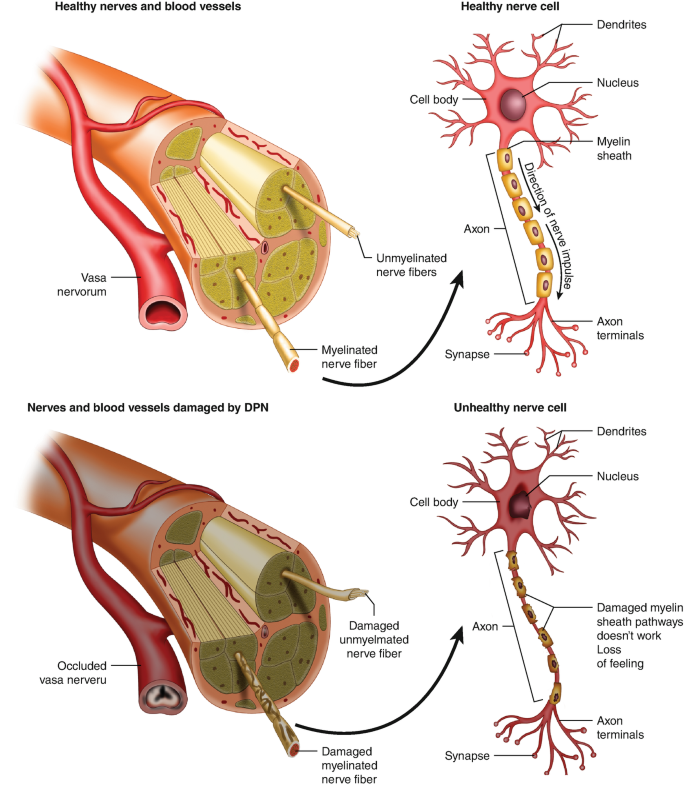Nerve-Targeted Rehabilitation Approaches for Diabetic Peripheral ...
